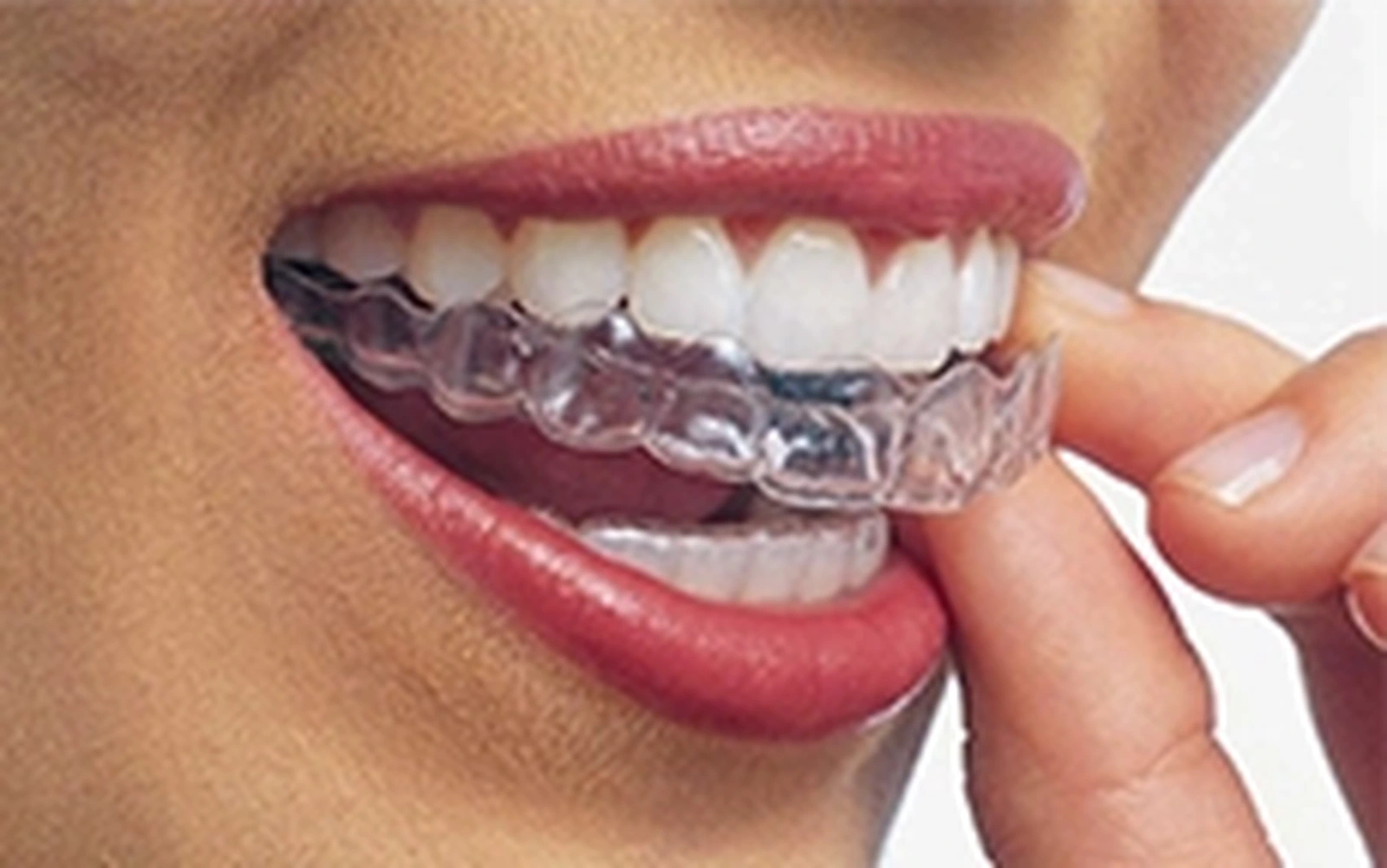 Alinhadores transparentes Invisalign